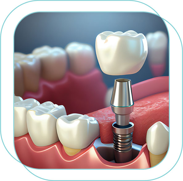 implante dental