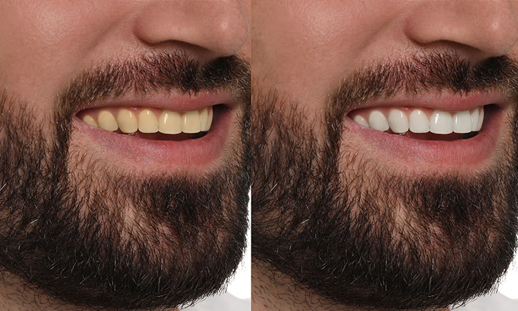 blanqueamiento dental antes y despues