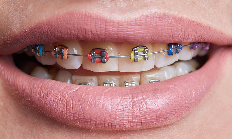 tratamiento de ortodoncia con brackets