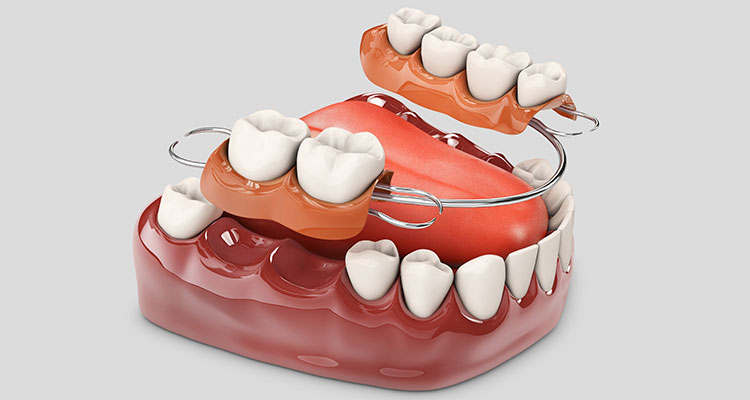 protesis dental removible