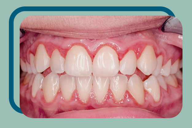 Limpieza periodontal: