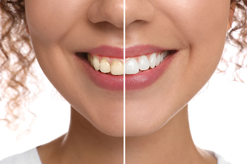 Blanqueamiento dental