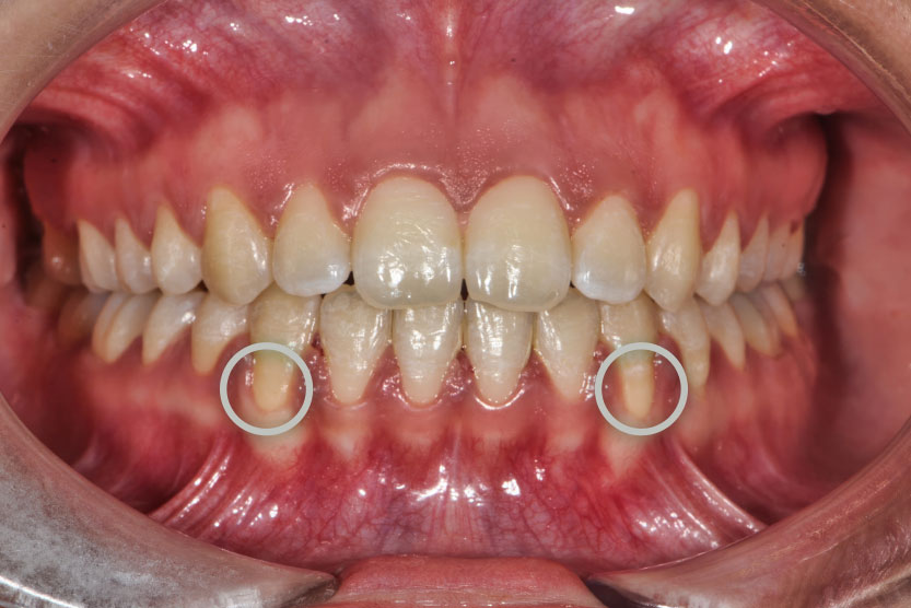 ortodoncia y periodontitis