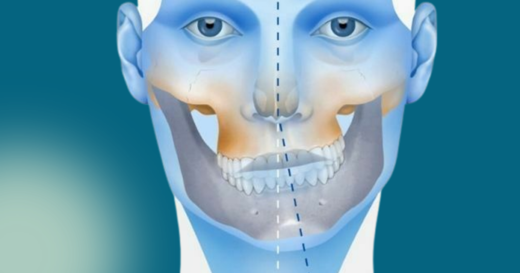Desviación mandibular
