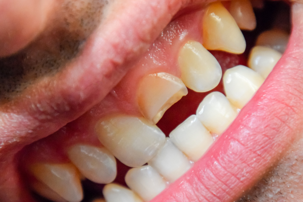 fractura dental